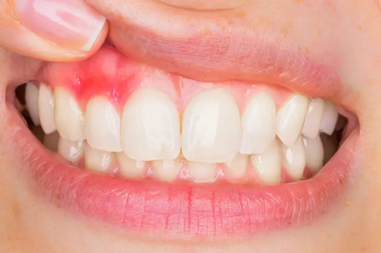 Gingivitis-common dental problems