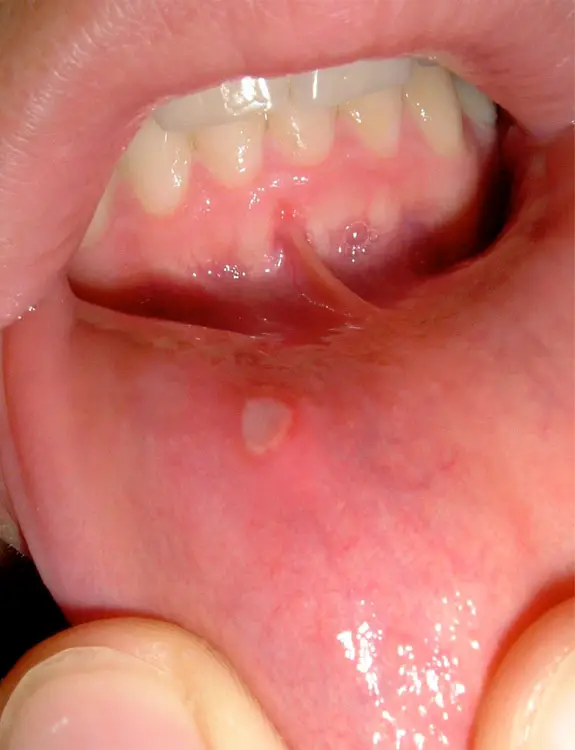 Mouth Sores-