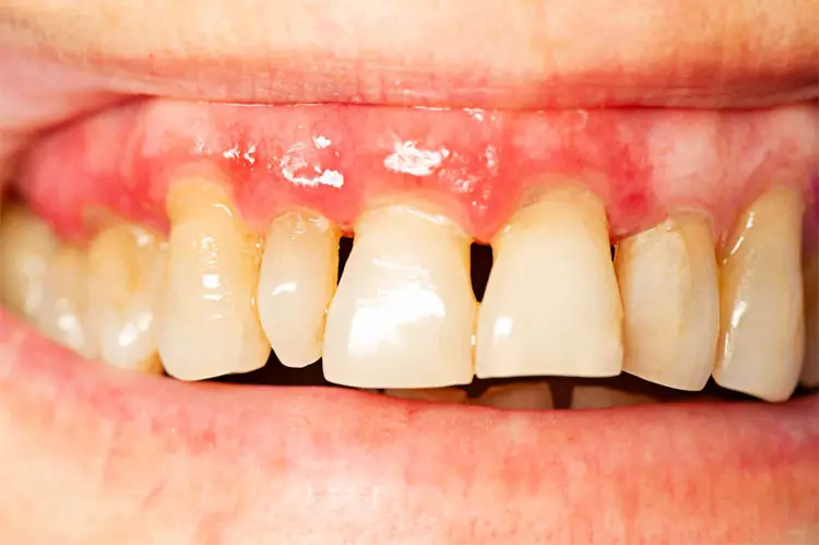 Periodontal Disease-common dental problems