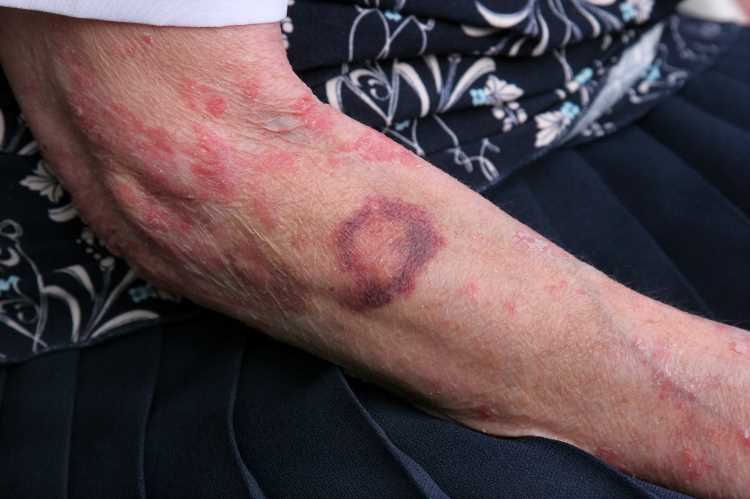 Physical Signs Of Elderly Abuse