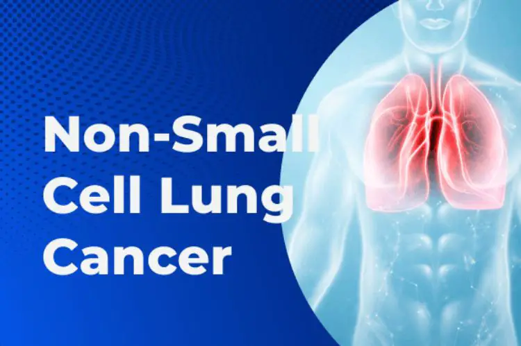 What Are The Types of Lung Cancer?