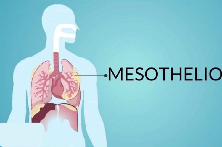Mesothelioma
